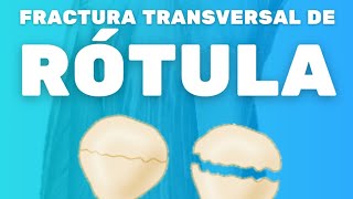 FRACTURA TRANSVERSAL DE RÓTULA [upl. by Salsbury925]