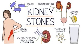 Understanding Kidney Stones [upl. by Yllet]