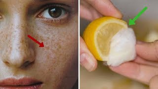 Want to Remove Freckles  Best Home Remedies to Get Rid of Freckles [upl. by Wurtz]