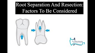 ROOT SEPARATION AND RESECTION Factors to be considered treatment of furcation involvement [upl. by Bink]