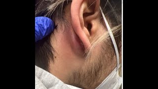 Mastoiditis vs Posterior Auricular Abscess andor Epidermoid Cyst [upl. by Aniram508]