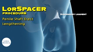 Suspensory Ligament Release procedure How its done [upl. by Melamie]