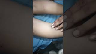 Varicose veins treatment sclerotherapydoctor pain treatment medical [upl. by Pernell]