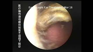 Regular cholesteatoma reexamination and cleaning of the ear [upl. by Ahsenahs]