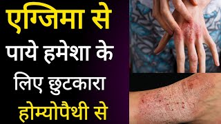 4 BEST HOMEOPATHY MEDICINE FOR ECZEMA  ATOPIC DERMATITIS खुजली एक्जिमा [upl. by Gridley]