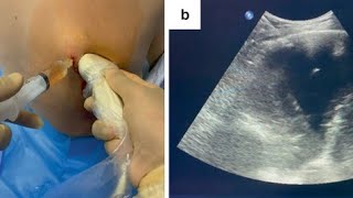 pleural fluid aspiration [upl. by Lebyram]