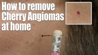 How to remove Red Skin Dots at home Quick amp Easy Cherry Angioma treatment [upl. by Nashom]