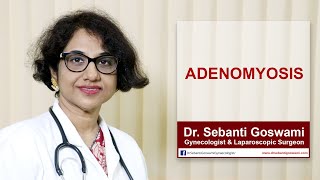 Adenomyosis Symptoms Causes and Treatment  What is Adenomyosis [upl. by Nednil]