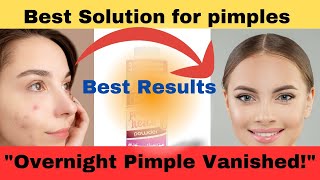 How to remove pimples fast overnight  X100 results  Must watch [upl. by Pimbley]