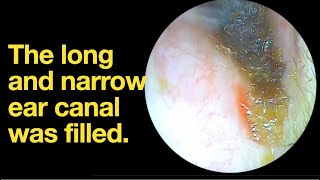 The long and narrow ear canal was filledear wax removal  ear cleaning  ASMR  relaxation  relax [upl. by Hanahsuar43]