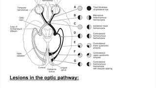 Optic nerve lesions Bitemporal hemianopia heteronymous hemianopiaHomonymous hemianopia [upl. by Herm]