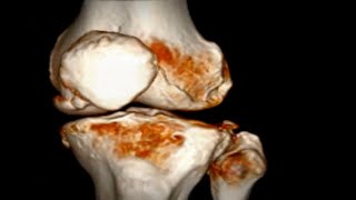 입체로 보는 무릎 관절염 3디 CT의 새로운 시각 3D CT Unveiling Knee Arthritis [upl. by Apfelstadt]