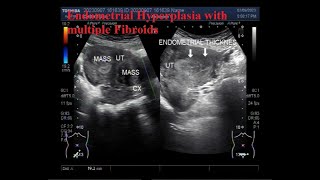 Endometrial Hyperplasia with multiple Fibroids [upl. by Ainolloppa]