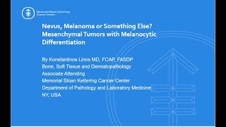 Nevus melanoma or something else Mesenchymal neoplasms with melanocytic differentiation [upl. by Acilgna]