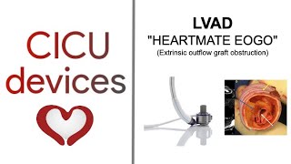 LVAD Heartmate EOGO Extrinsic Outflow Graft Obstruction lvad [upl. by Rollet]