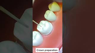 Crown Preparation dentalstudents [upl. by Orenid]