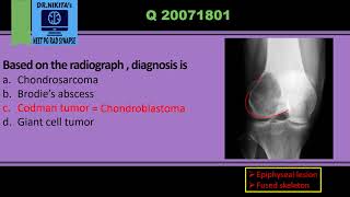 Differentiating epiphyseal lesions Chondroblastoma vs Giant cell tumor [upl. by Vashti]