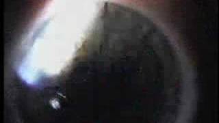 My Lasik Procedure in Denver 2006 Spivack Vision Center [upl. by February]