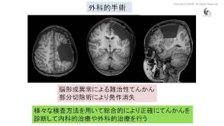 治験市民講座「てんかん治療と診断の最前線」：最新の治療や治験 [upl. by Maurie]