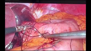 Toupet Fundoplication with Hiatal hernia repair [upl. by Gies]