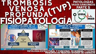 TROMBOSIS VENOSA PROFUNDA FISIOPATOLOGÍA  GuiaMed [upl. by Keener]