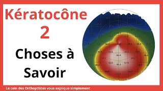 Comment soigner un kératocône  Comment savoir si on a un kératocône [upl. by Nhguavoj887]