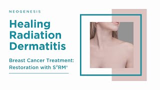 Radiation Dermatitis after Breast Cancer Treatment Restoration with S²RM® [upl. by Hamlani]