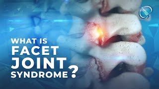 What is Facet Joint Syndrome [upl. by Susan]