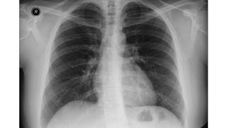 chest xray  Idiopathic Pulmonary Fibrosis [upl. by Ayital]