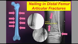 Nailing Distal Femur Articular Fracture Basics and Stepwise Explanation [upl. by Holms]