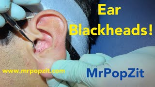 Ear Blackheads and more Tricky extractions deep in the ear Many waxy comedones removed [upl. by Hernardo]