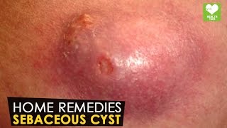 Sebaceous Cyst  Home Remedies  Health Tone Tips [upl. by Eerihs]