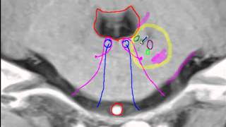 Anterior inferior cerebellar artery [upl. by Veron]