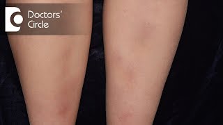 How to manage Lichen Planus present in the legs  Dr Rajdeep Mysore [upl. by Arica]