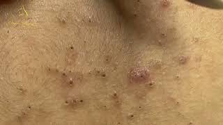 Loan Nguyen Acne Treatment 15566 [upl. by Nicki983]