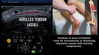 Ultrasound Tutorial MSK Series Achilles Tendon  Radiology Nation [upl. by Aisatsanna]