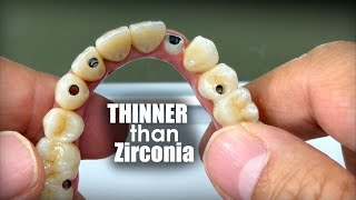 This Restoration Is Thinner amp Stronger than Possible With FullMouth Zirconia [upl. by Anaeco]