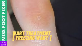 Wart Treatment  Freezing Wart   Miss Foot Fixer [upl. by Aldus791]