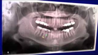 CBCT Scan using Veraviewepocs 3De [upl. by Raina718]