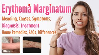 Erythema marginatum overview meaning signs and symptoms diagnosis treatment home remedies FAQs [upl. by Teteak191]