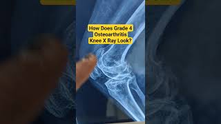 How Does Grade 4 Osteoarthritis Knee X Ray LookDr Sai Chandra kneeosteoarthritis kneexray [upl. by Ayamahs731]