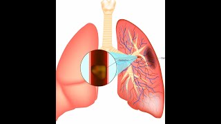 Pulmonary Embolism [upl. by Patterson369]