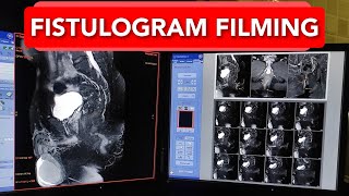 Fistulogram MRI scan Filming Technique [upl. by Annabella]