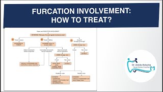 DECISION MAKING FURCATION INVOLVEMENT HOW TO TREAT DR ANKITA KOTECHA DENTAL STUDIES SIMPLIFIED [upl. by Joana]