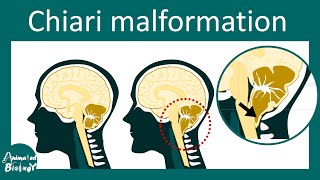 Chiari Malformation and Treatment  Type I and II Chiari malformation [upl. by Sansen]