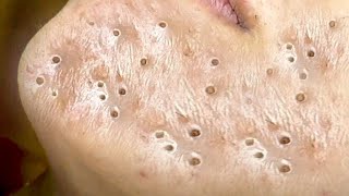 Big Cystic Acne Blackheads Extraction Blackheads amp Milia Whiteheads Removal Pimple Popping  8387 [upl. by Raeann267]