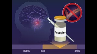 Tenecteplase for Ischemic Stroke at 45 to 24 Hours  NEJM [upl. by Zebadiah]