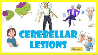 Cerebellar lesionsexamination signs lesions and ataxic gait heel knee shin test [upl. by Jeff]