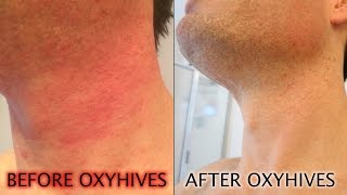 How To Get Rid Of Hives With The OxyHives Hives Treatment [upl. by Eadrahc]