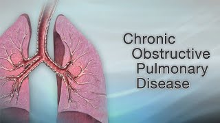 COPD  chronic obstructive pulmonary disease  copd bronchitis emphysema asthma lungs [upl. by Garda120]